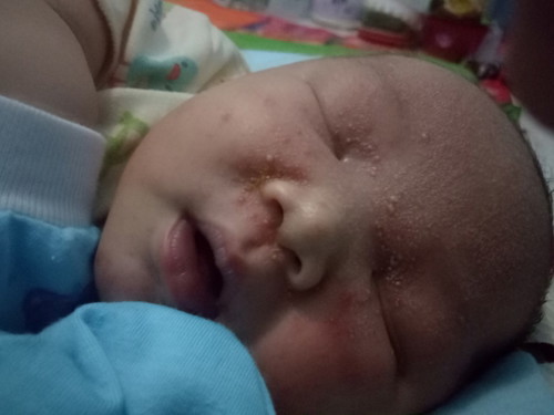 bintik putih dan kemerahan seperti ada nanah pada bayi