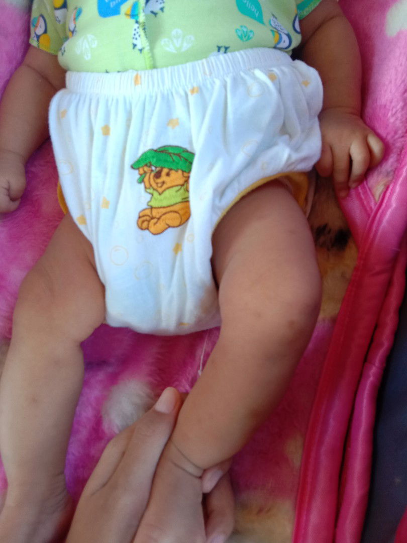 Bekas gigitan nyamuk