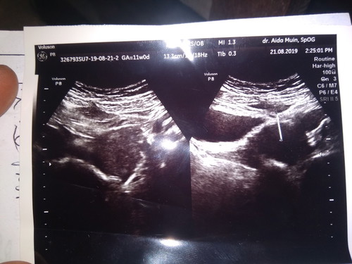 Bund saya ingn hamil ank kedua gmn ea bund.