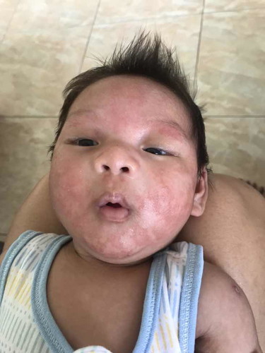 หน้าลูกเป็นแบบนี้ ต้องทำยังไงถึงจะหายคะ