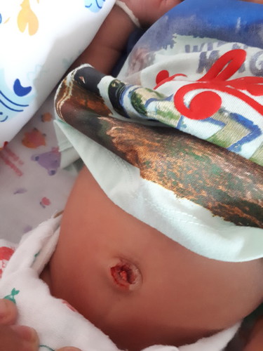 สะดือพึงหลุด