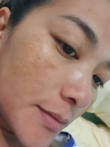 ฝ้า
