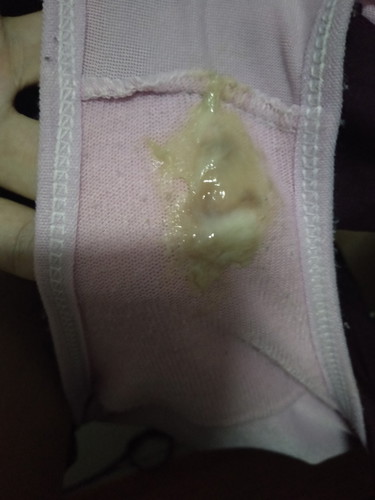 แชร์ประสบการตอน 38+1 และถามแม่ๆใครเป็นบ้าง