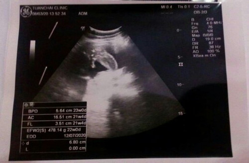 ตอนนี้ประมาณ 22 Week+ แล้วคะแต่ลูกน้ำหนักน้อย...