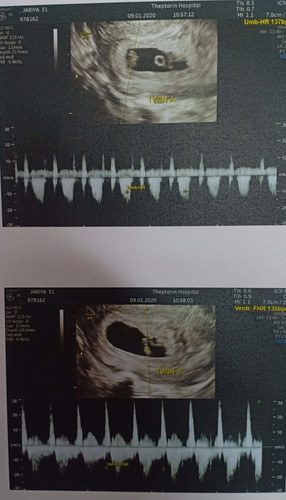 ท้องแฝด3 ใครมีวิธีแก้แพ้ท้องยังไงบ้างค่ะ ตอนนี้ได้7 สัปดาห์ค่ะ