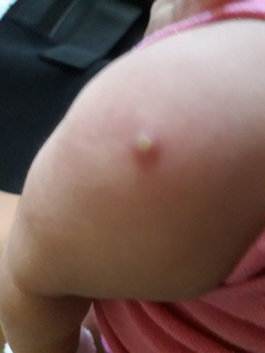 infection