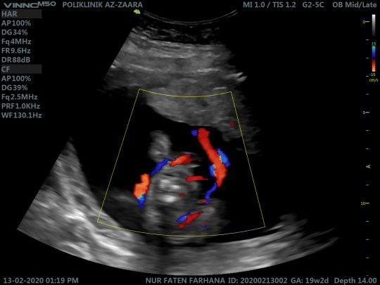 Tali pusat berpusing