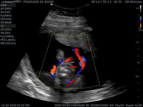 Tali pusat berpusing