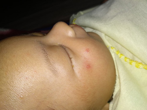 Merah merah di pipi bayi