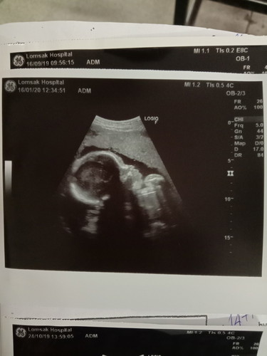 เราท้องได้ 26w2d คนแถวบ้านบอกว่าท้องเล็ก