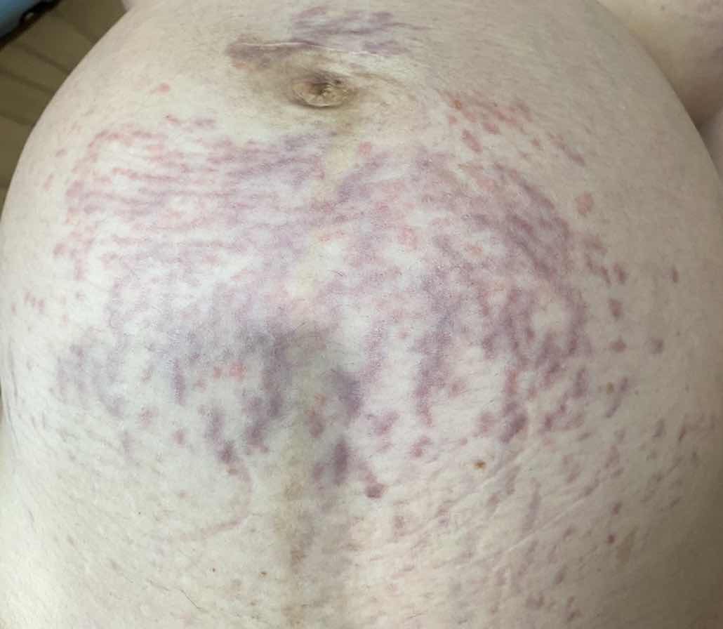 แม่ๆคะ มีใครเคยเป็นผื่นการตั้งครรภ์บ้างคะ