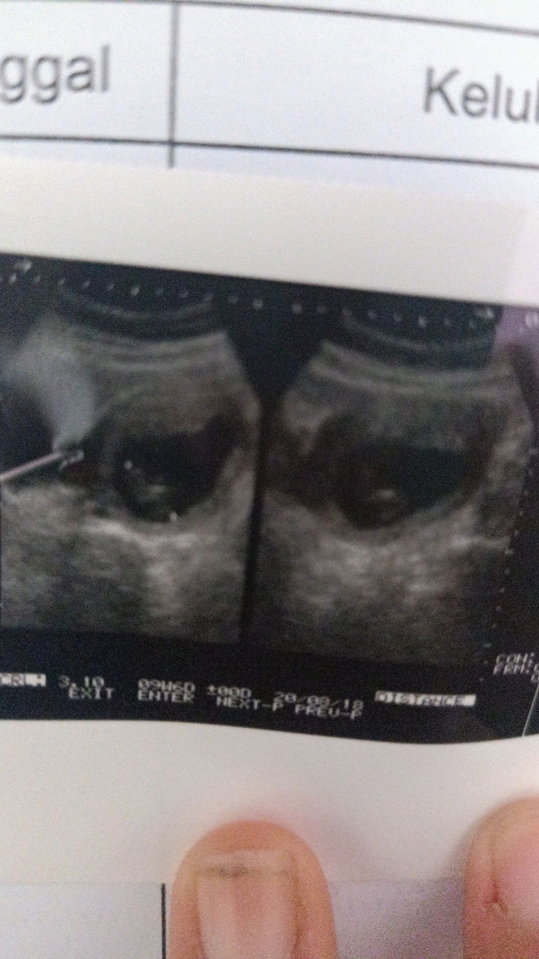 janin tidak berkembang