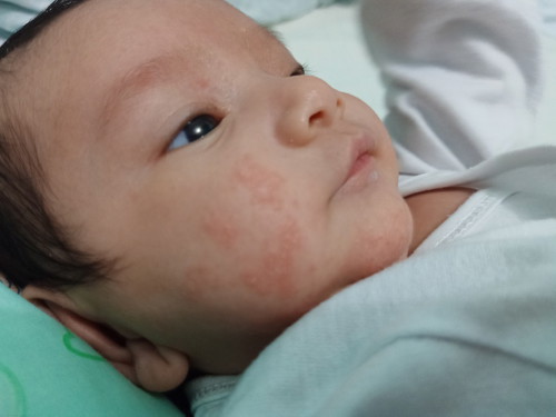 Baby's skin rash