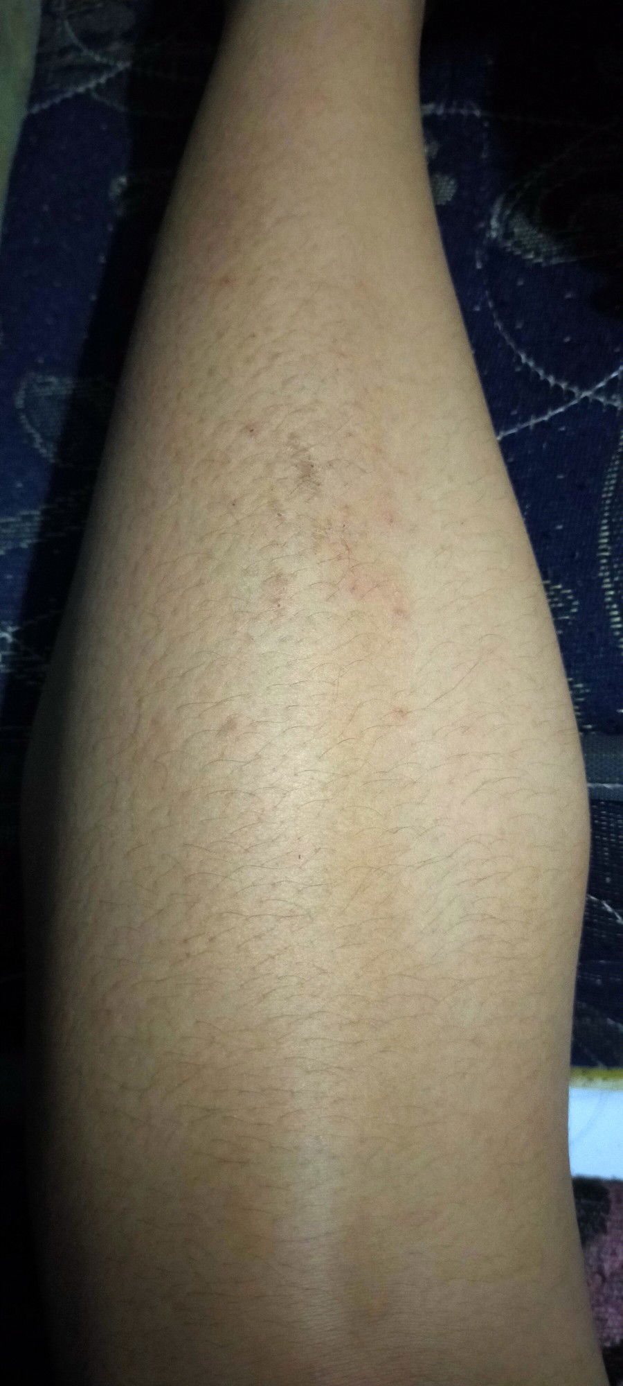 nyembuhin gatal kayak beruntus di betis ..