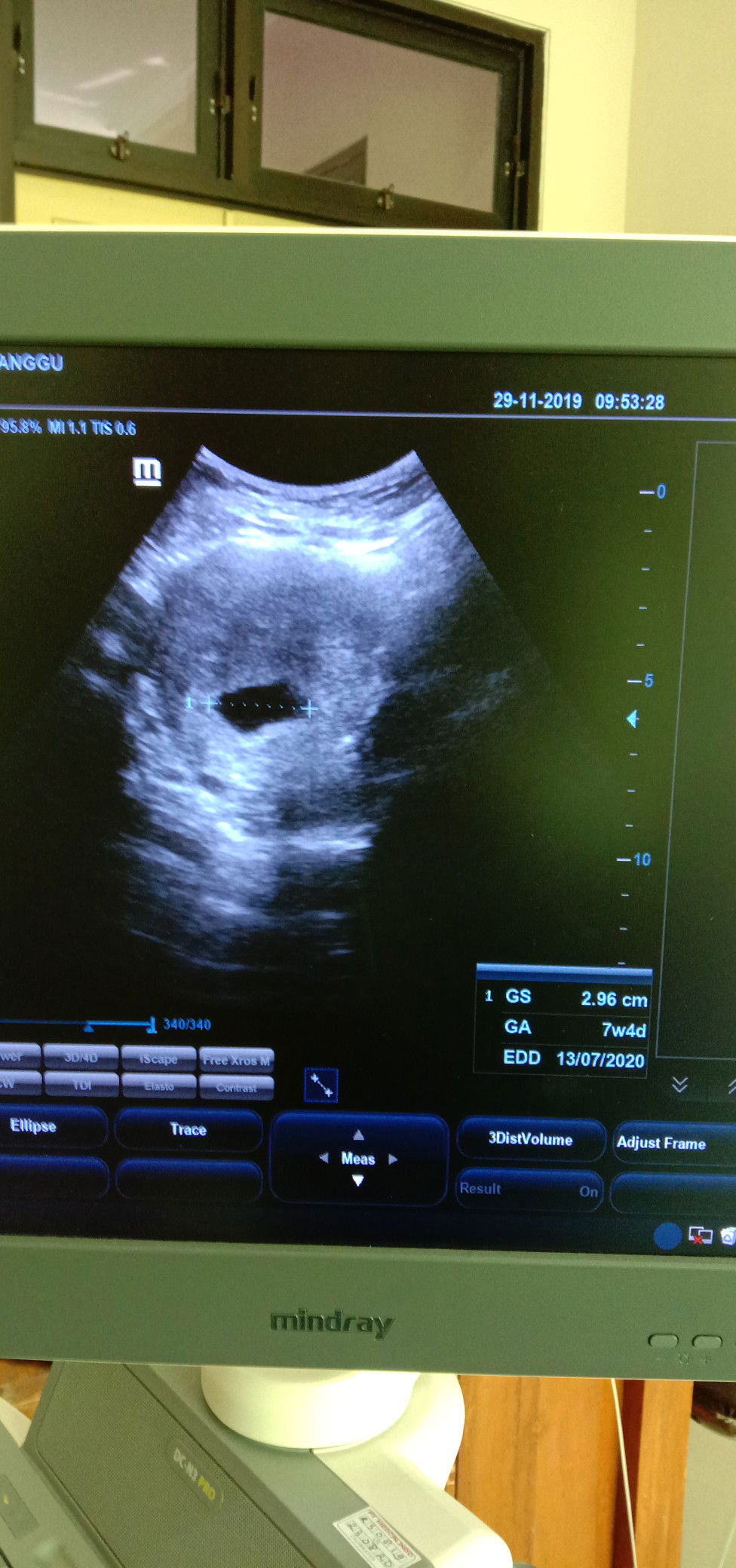 UK bidan sama USG beda