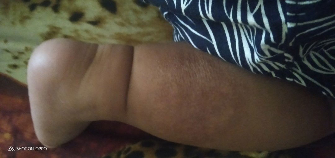 cara ngilangin bekas luka