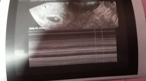 threatening abortion