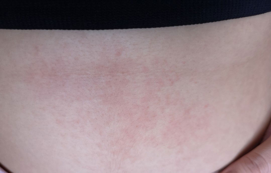 เป็นผื่นค่ะ คันมากๆ ตอนนี้อายุครรภ์ ประมาณ 5 สัปดาห์