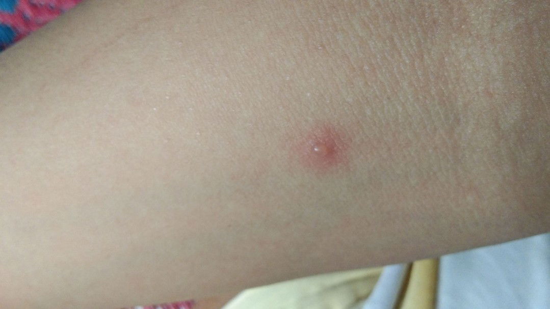 cacar Air di kehamilan 6 bulan