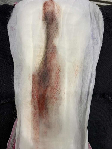 Lepas D&C , masih keluar darah sampai 3 minggu ++. Darah Hitam . Normal ke ?