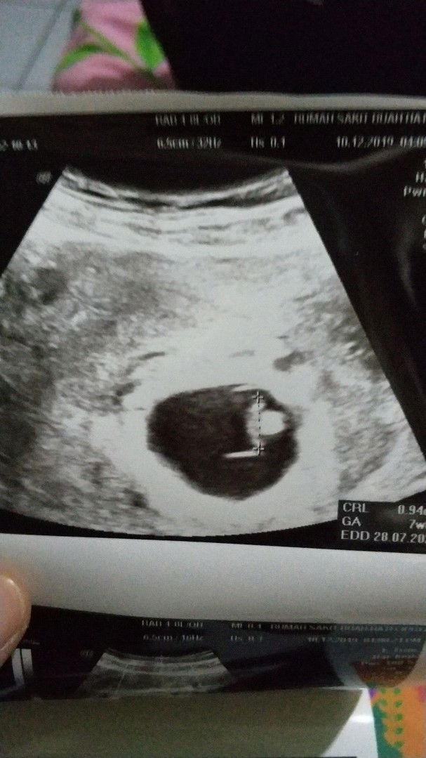 tidak ada detak jantung