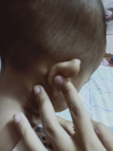 น้องมีก้อนเนื้อหลังหู