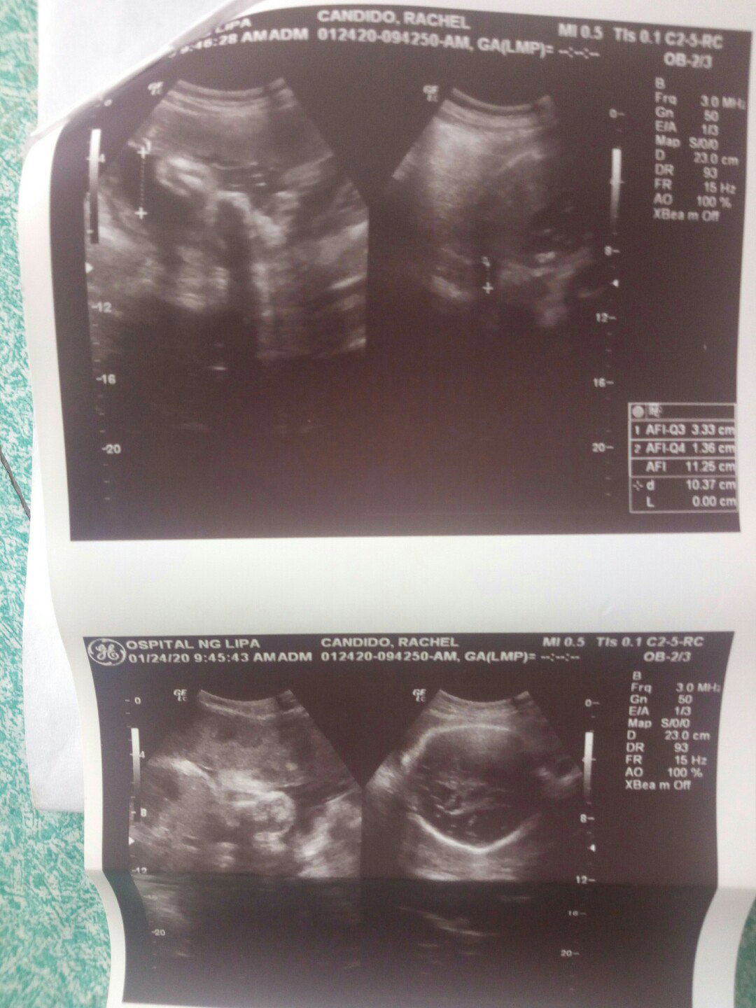 Ultrasound