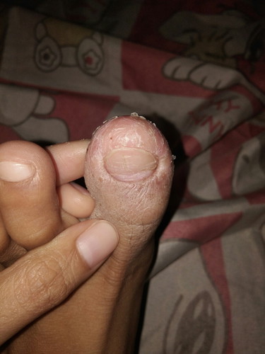 dry toe