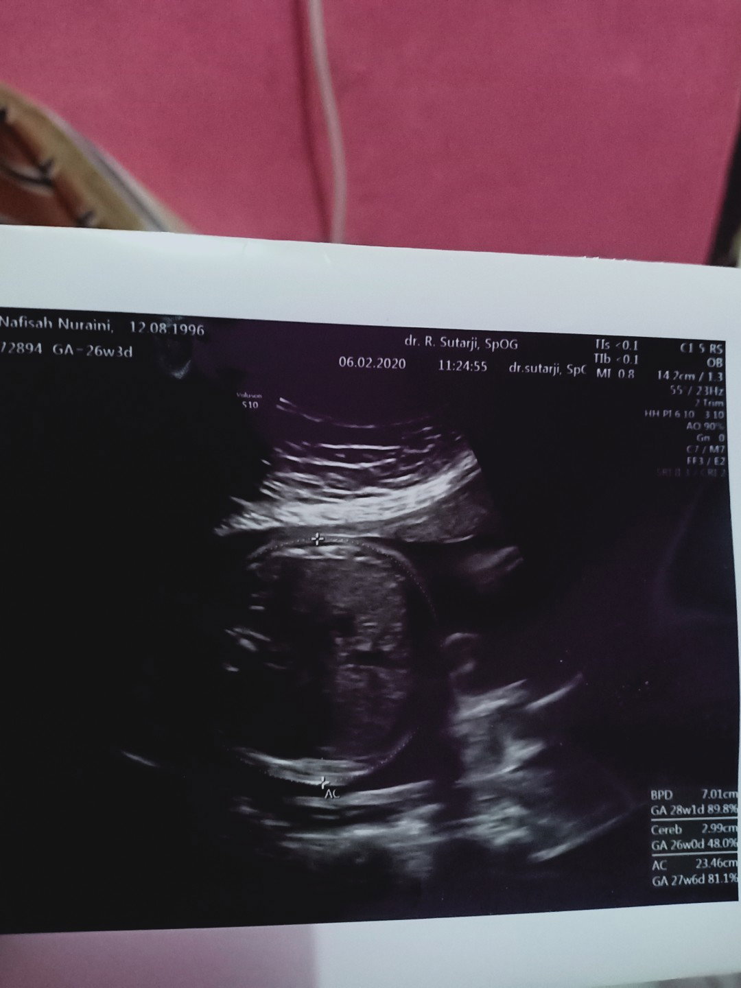 lingkar perut bayi