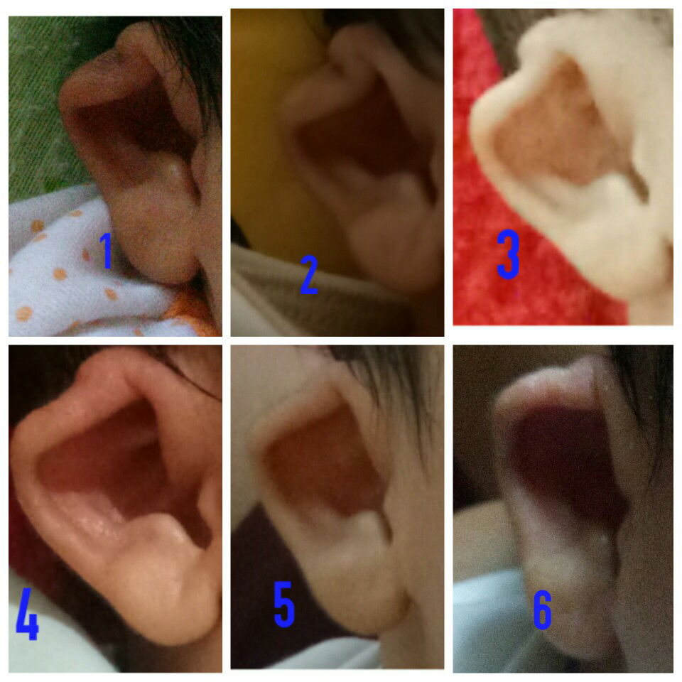 Alhamdulillah, telinga anak kembali normal