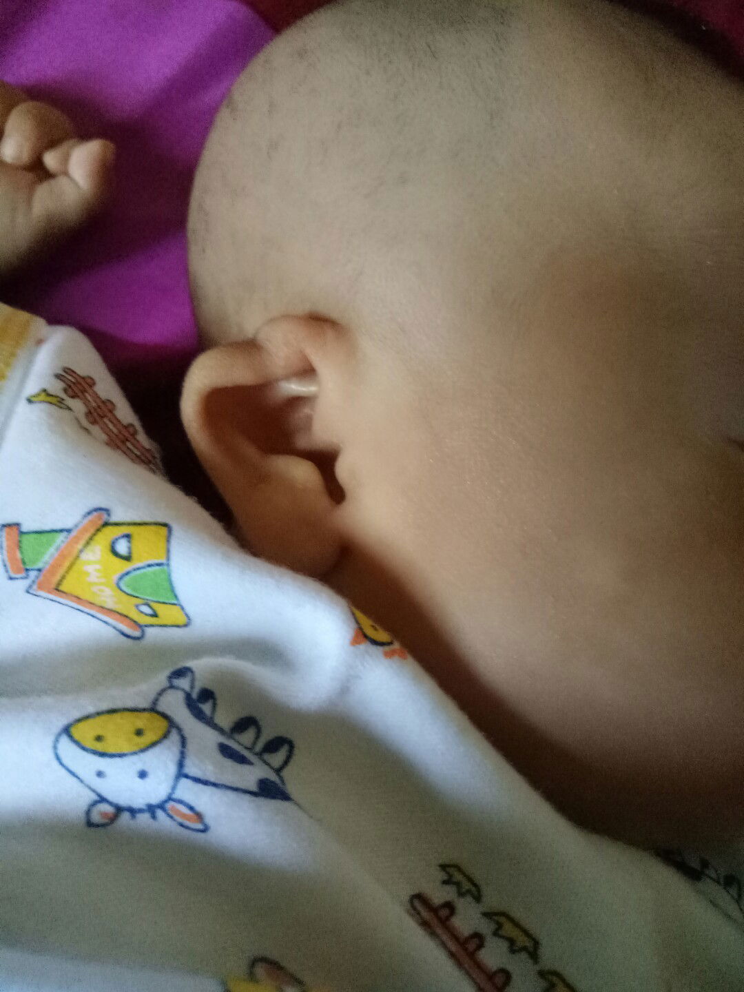 telinga anak melipat kedalam