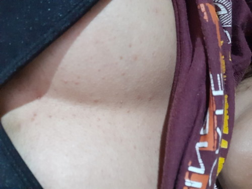 Need Help po! RASHES