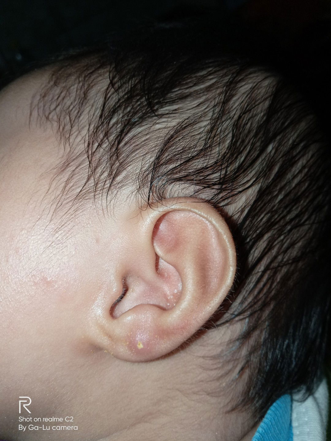 kluar nanah putih pasca tindik