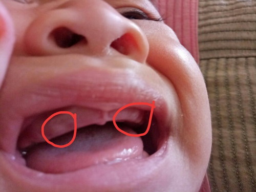 ลูกสาว 7 เดือน 24 วัน ฟันเขี้ยวขึ้นก่อนฟันคู่หน้า