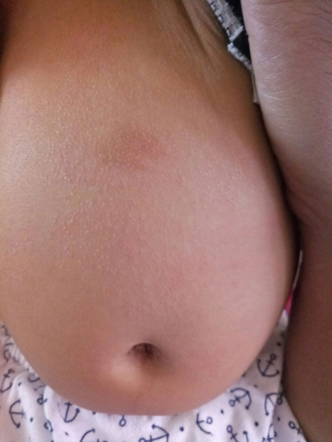 ผื่นขึ้นบริเวณหน้าท้อง