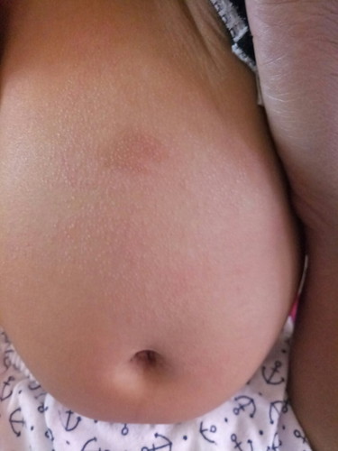 ผื่นขึ้นบริเวณหน้าท้อง