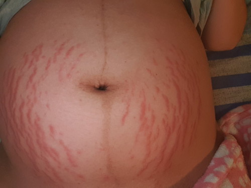 stretchmark