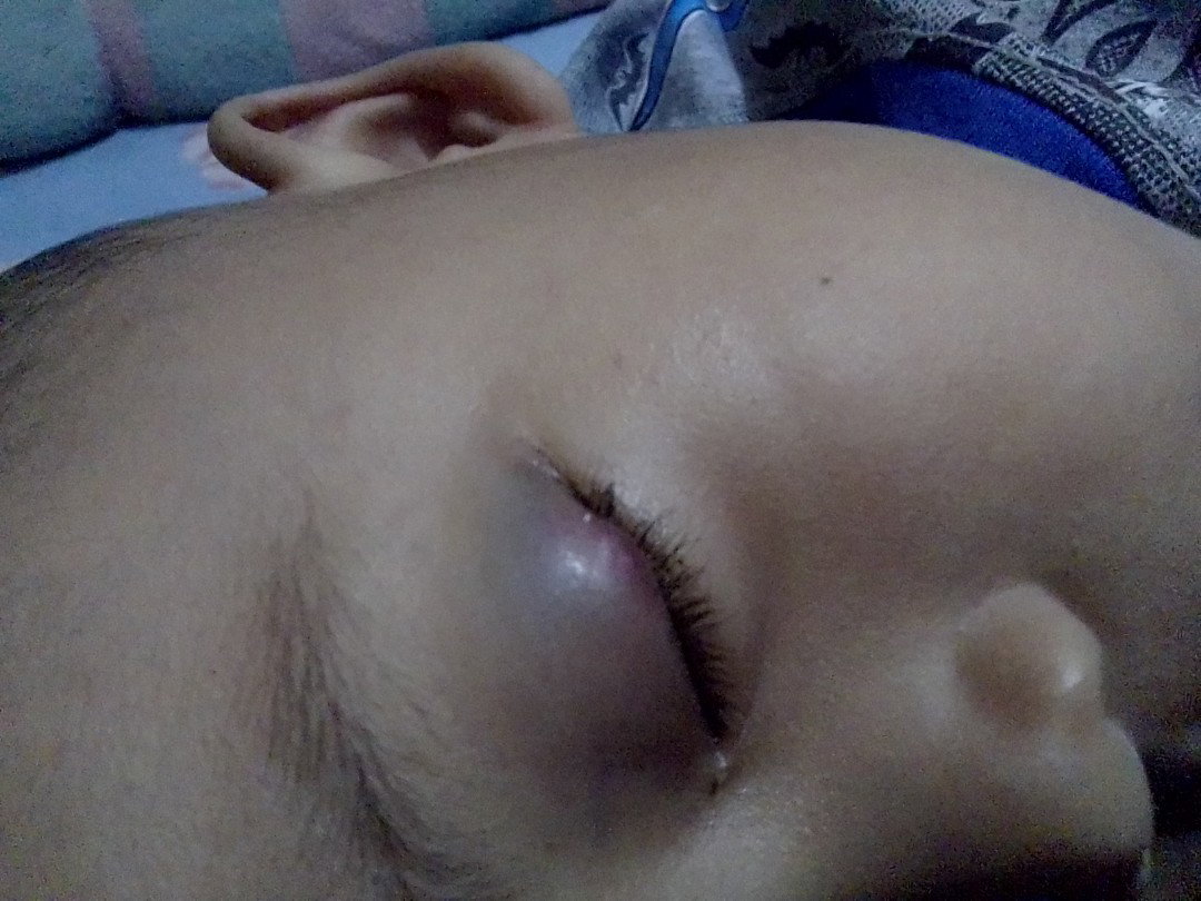 bintitan atau radiasi hp