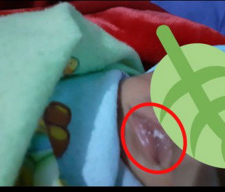 sariawan atau sisa susu