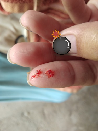 เลือดออกจมูก