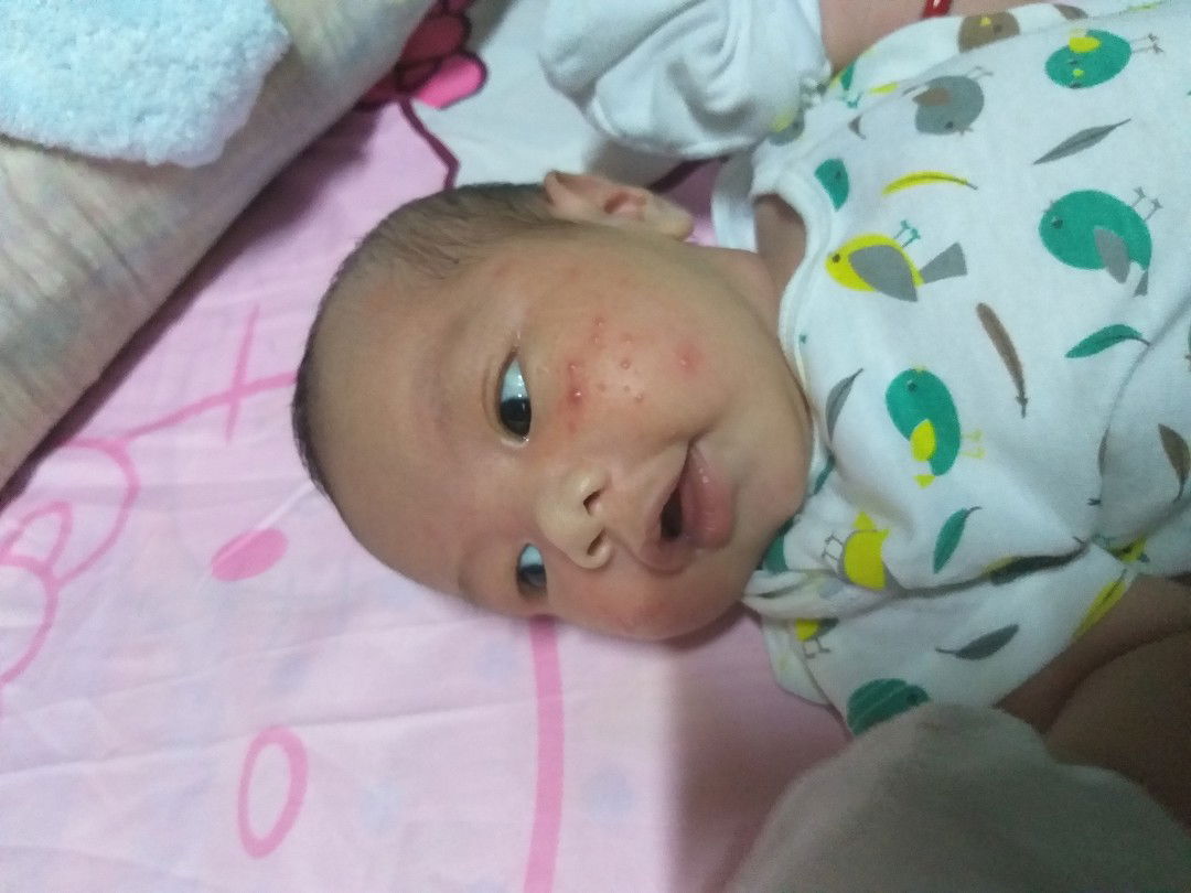 Rashes ni baby