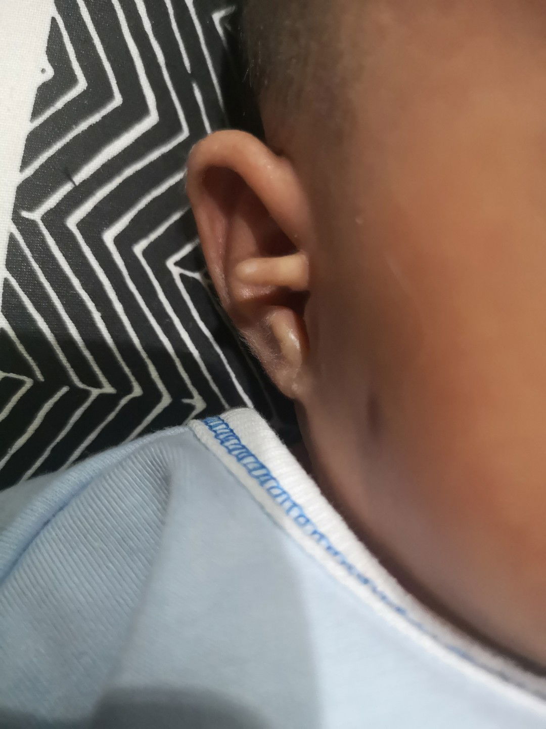 Skin Tag/ Isi Lebih di Telinga Bayi
