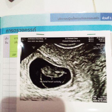 กังวลจังพบตัวเด็กเเต่ไม่เจอหัวใจเด็กเต้น