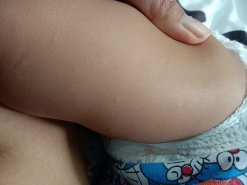 สอบถามคะ น้องเป็มตุมเล็กๆ ขึ้นตามแขน ขา และแก้มตะ