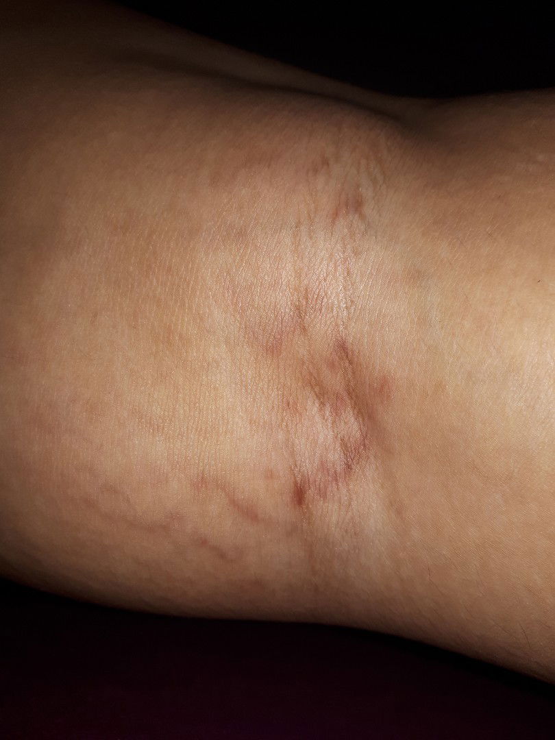 Varises atau Stretch Marks di kaki belakang