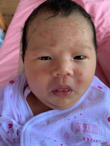 ลูกเป็นผื่นแบบนี้คืออะไรค่ะ
