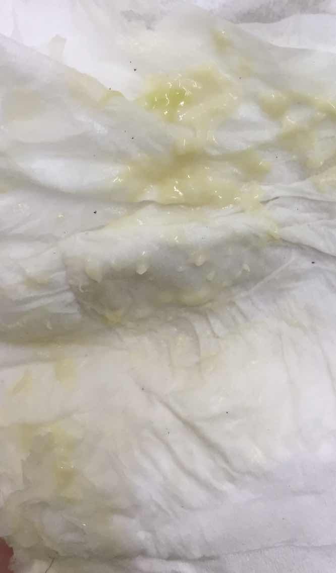 สีตกขาวแบบนี้อันตรายไหมค่ะ!!