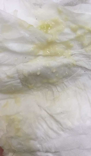 สีตกขาวแบบนี้อันตรายไหมค่ะ!!