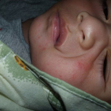 merah merah pada bayi