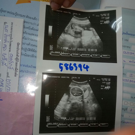คบกับแฟนอีก10วันจะได้5เดือนแล้วค่ะแต่ตอนนี้ท้องคุณหมอบอกลูก4เดือนแล้วกลัวแฟนไม่มั่นใจค่ะว่าเป็นลูกเค้า